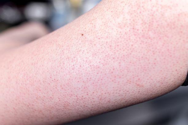 毛囊角化症严重么