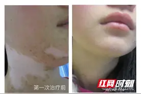 花季少女白斑愈后复发 且听专家支招图片