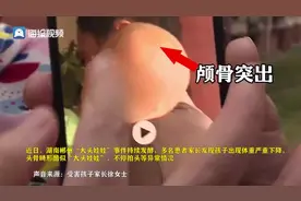 假奶粉事件家长：孩子两岁半还走不稳 担心留后遗症图片