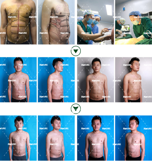 移植后吃了花胶 2026年移植后吃了花胶会怎么样