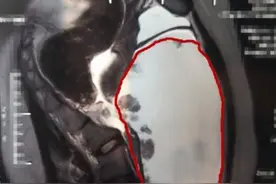 15岁少女突然发胖，体内竟藏20多厘米恶性肿瘤！腹胀腹痛千万不能大意图片