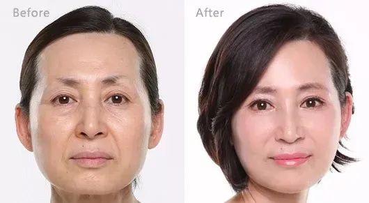 经常喝胶原蛋白有什么副作用 2026年经常喝胶原蛋白有什么副作用和危害