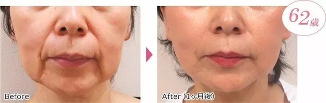 经常喝胶原蛋白有什么副作用 2026年经常喝胶原蛋白有什么副作用和危害