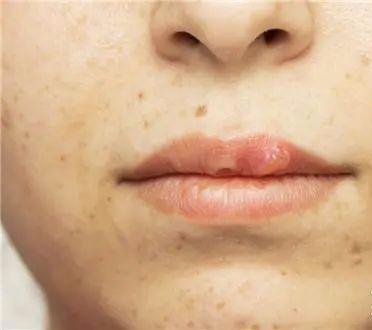 长期吃胶原蛋白有什么副作用 2026年长期吃胶原蛋白有什么副作用和危害