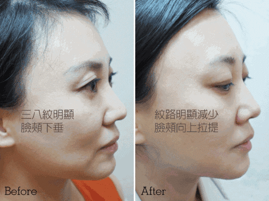 天天喝胶原蛋白对身体有害吗 2026年天天喝胶原蛋白的好处