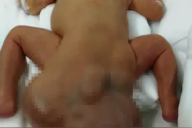 龙凤胎中的妹妹出生体重2.7kg 臀部的肿瘤就占了1kg图片