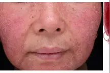 最近的脸又痒、又红、还发烫，华西专家说，你多半是遭了敏感性皮肤了！图片