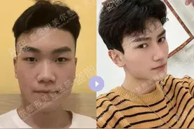 青岛伊美尔杨文国：混血小翘鼻为什么采用肋软骨？图片