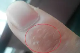 痒痒痒！一到夏天手指就长小水泡，最近好多人中招图片