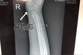 疼了4天才带娃就医，8岁女孩手腕取出1.3cm钢针图片