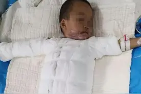 揪心！因邻居逗弄，2岁男童跌入热油桶，全身大面积烧伤！生命垂危…别再这样逗娃了图片