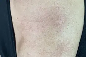 热热热，痒痒痒，小心“夏季皮炎”来袭图片