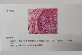 牙龈长“肉蛋”竟然是癌！滨州口腔专家提醒这个现象一定早诊治图片