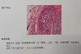 牙龈长“肉蛋”竟然是癌！滨州口腔专家提醒这个现象一定早诊治图片