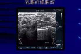 济南乳腺病医院：乳腺纤维瘤会自动变小或者消失吗？图片