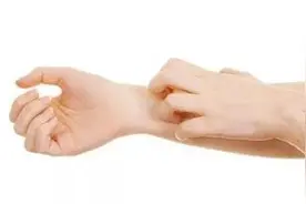 干货！带你了解汗疱疹那些事儿图片