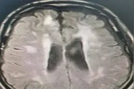 爱打“哈欠 不一定是困了 可能是这个疾病找上门图片