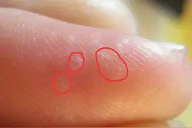 注意｜手上长水泡瘙痒难消？医生提醒：这症状夏天高发图片