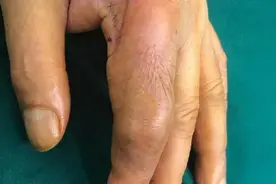 当心！男子被鱼刺伤手，肿了两个月，手术后还要服药半年以上图片