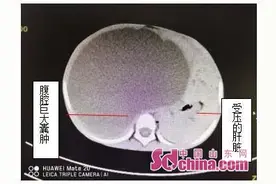 2岁男孩腹胀如鼓，齐鲁儿外科微创手术解病忧图片