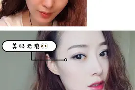 大揭秘！都是割双眼皮，为啥别人恢复这么快，就你一直肿？图片
