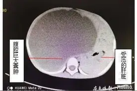 青岛两岁男孩腹胀如鼓却无不适，原是长了巨大肝囊肿图片