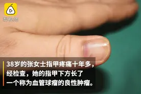 别不在意！女子指甲疼痛十年一查竟是肿瘤，医生：女性患者偏多图片