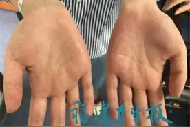 宁德女孩双手出汗近20年，连握手都害怕！就这样根治了图片