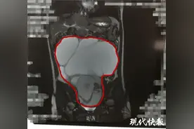14岁女孩肚子变大，家长以为是长胖，看到检查结果惊呆……图片