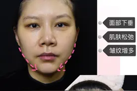 网红、女明星都喜欢做的面部埋线提升，究竟好在哪儿？图片