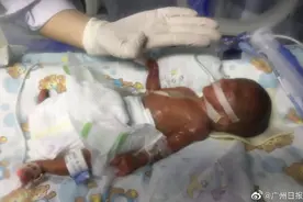 出生1斤半，超早产迷你宝宝住NICU百多天终于出院了图片