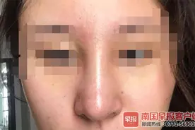 南宁一女子隆鼻后鼻头“有点大”，经协商医院退还手术费4万余元图片