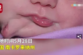 美国一女婴脸上长出第二张嘴，百年来仅35例图片