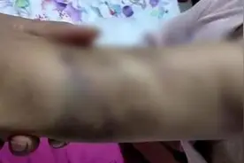 作业未完成小学生被打得浑身淤青，涉事老师停职视频封面
