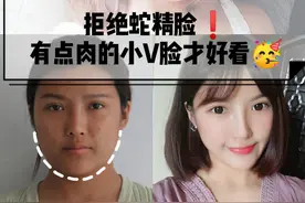 想要巴掌脸，却惨遭拒绝？面部吸脂不是脸越小越好图片