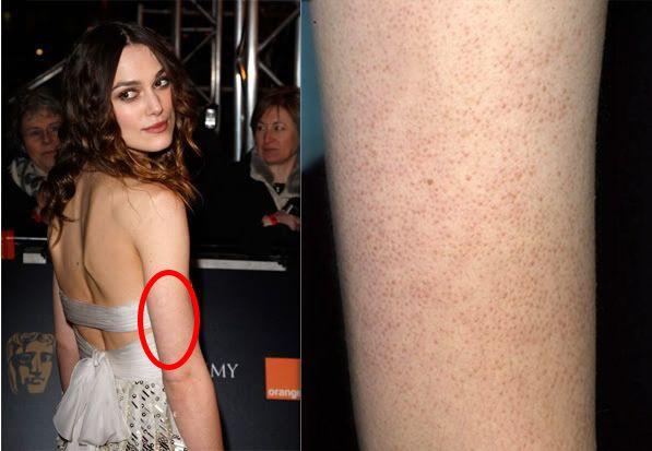 最近皮肤像鸡皮疙瘩