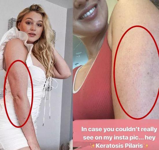 局部皮肤变粗糙摸起来像鸡皮疙瘩