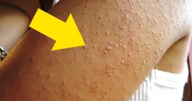 最近皮肤像鸡皮疙瘩