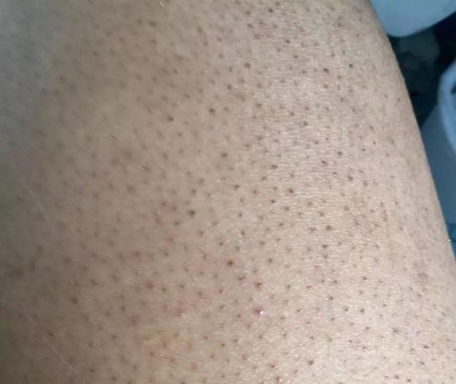 局部皮肤变粗糙摸起来像鸡皮疙瘩