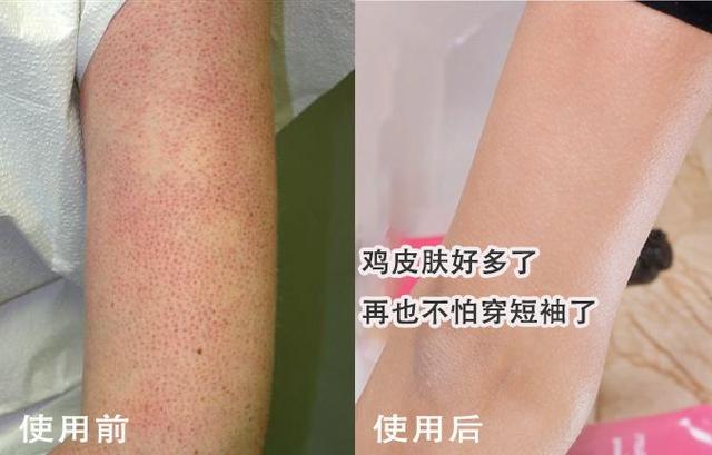 局部皮肤变粗糙摸起来像鸡皮疙瘩