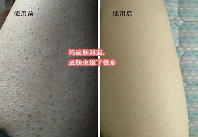 最近皮肤像鸡皮疙瘩