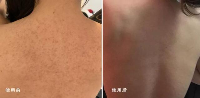 局部皮肤变粗糙摸起来像鸡皮疙瘩