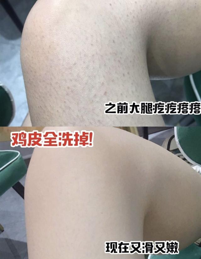 局部皮肤变粗糙摸起来像鸡皮疙瘩