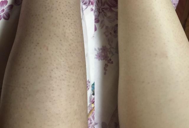 局部皮肤变粗糙摸起来像鸡皮疙瘩