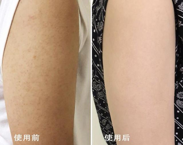 最近皮肤像鸡皮疙瘩