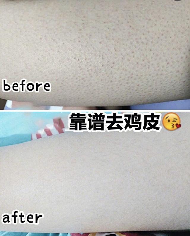 最近皮肤像鸡皮疙瘩