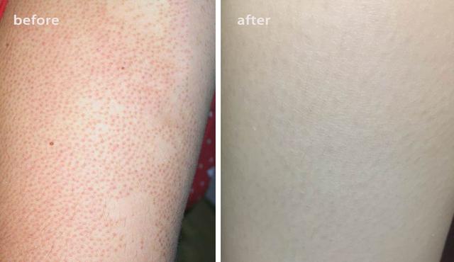 局部皮肤变粗糙摸起来像鸡皮疙瘩