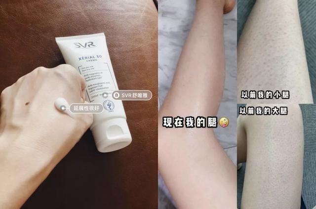 局部皮肤变粗糙摸起来像鸡皮疙瘩