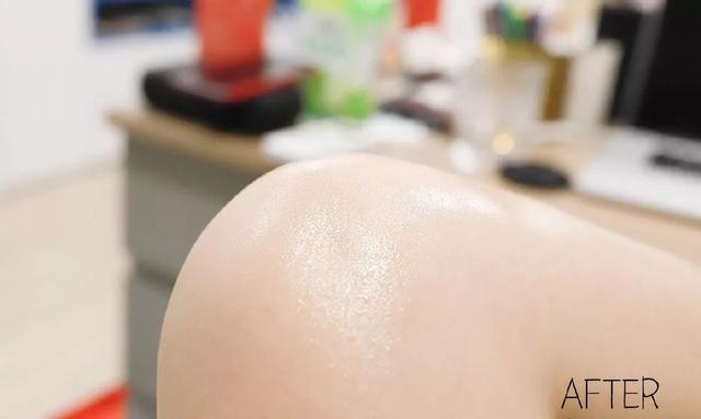 最近皮肤像鸡皮疙瘩