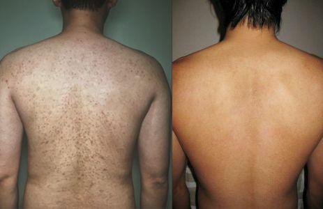 最近皮肤像鸡皮疙瘩